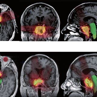 Stereotactic radiation therapy dose plan in BrainLab/iPlan, of a right ...