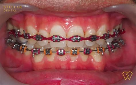 Braces Colors: Top Picks For 2023 - Stellar Dental