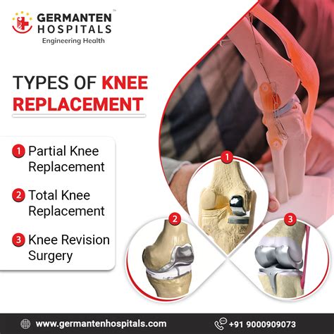 The Three main types of knee replacement surgery are: total knee ...