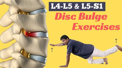 6 Best Diffuse Disc Bulge at L4-L5 and L5-S1 Treatment Exercises - YouTube