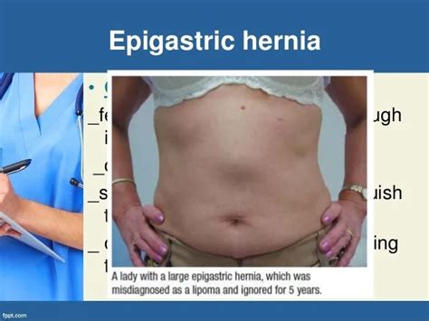 Epigastric abdominal hernia symptoms – Prnso