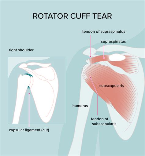 Rotator Cuff Injury: Treatments, Symptoms, and Diagnosis | Rotator cuff ...