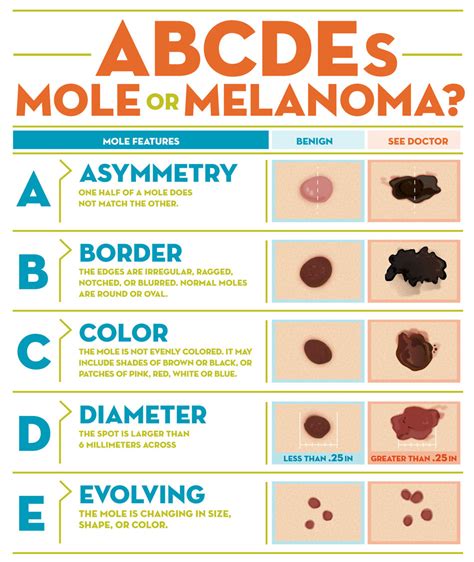 Abcde Rule Of Skin Cancer Detection