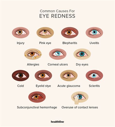 20 Causes, Symptoms, and Complications of Red Eyes