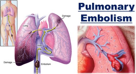 Pulmonary Embolism - Causes, Signs & Symptoms, Diagnosis, Treatment