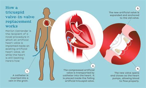 Advances in heart valve replacement technology are providing new hope ...