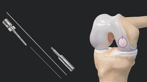 Arthrex - Treatment of a Femoral Condyle Cartilage Defect Using the ...