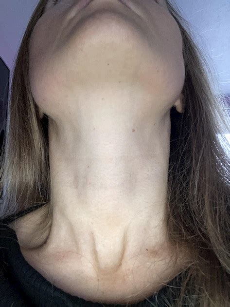 Swollen Neck Thyroid