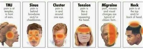 Types Of Headaches Chart, Different Headaches, Headache Types, Tension ...