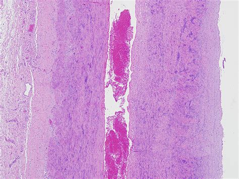 Dissecting Aneurysm