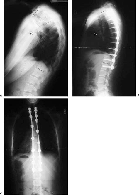 Scheuermann’s Kyphosis | Neupsy Key