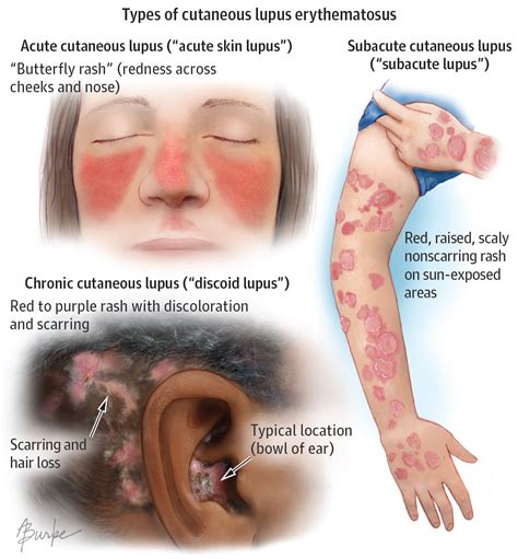 Cutaneous lupus erythematosus (CLE) is lupus affecting the skin. In ...