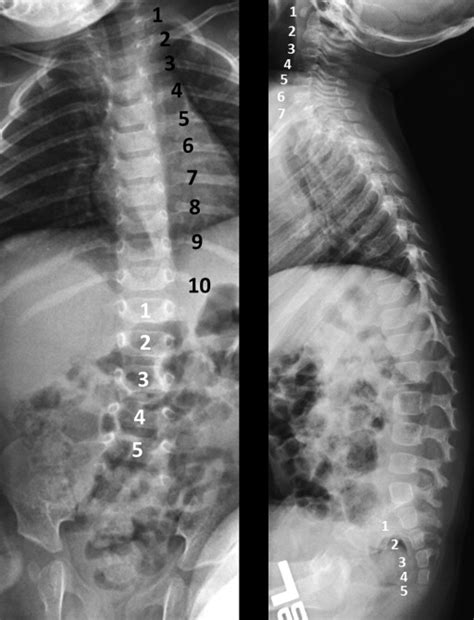 Systemic Diagnostic Testing in Patients With Apparently Isolated Uveal ...