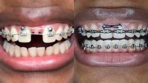 how do braces work to close gaps - Cherie Verdin