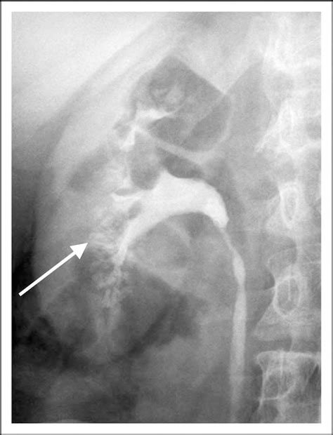 The Diagnostic Dilemma of Medullary Sponge Kidney | Kidney Stone ...