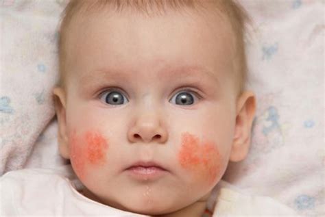 All You Need to Know About Slapped Cheek Disease in Children