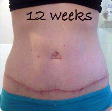 Pictures of swelling after tummy tuck » Tummy Tuck: Prices, Photos ...