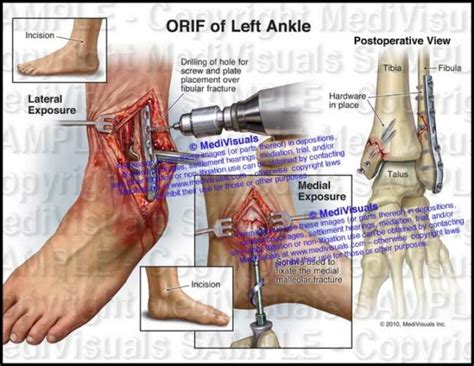 ORIF of Left Ankle - Medivisuals Inc.