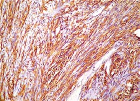 Cellular pleomorphism and mitoses (H& x200). Figure 6: Diffuse ...