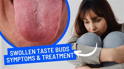 What are swollen taste buds and Causes Symptoms and Treatment - YouTube