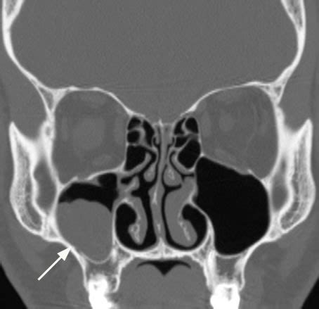 Maxillary Diseases