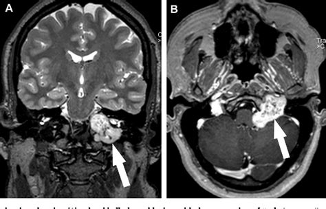 Figure 1 from Jugular foramen schwannoma mimicking paraganglioma: case ...