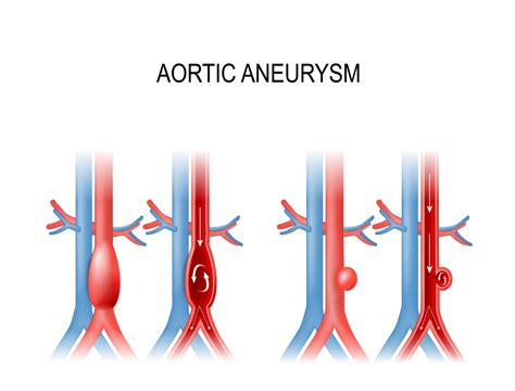 Recommendations for Abdominal Aortic Aneurysm Screening - AAPC ...