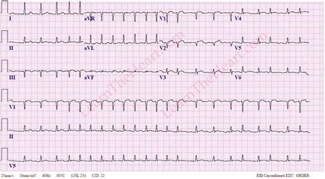 Atrial Fibrillation with Rapid Ventricular Rate (Example 3) | Learn the ...