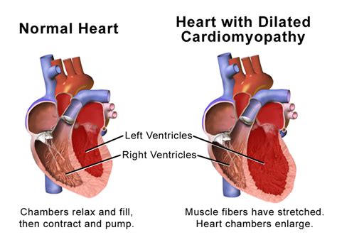 Lbbb And Dilated Cardiomyopathy | carfare.me 2019-2020