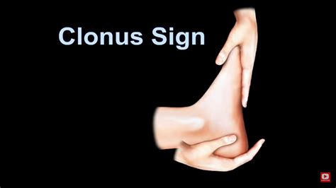 Clonus Sign for Cervical Myelopathy — OrthopaedicPrinciples.com