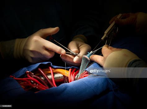 Heart Surgery Aortic Valve Replacement High-Res Stock Photo - Getty Images