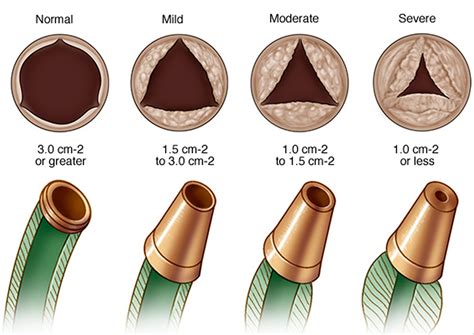 Aortic Valve Stenosis - Causes, Symptoms, Life Expectancy, Treatment