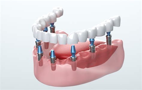 Why Choose A Dental Implant Dentist? - Rogerpeele