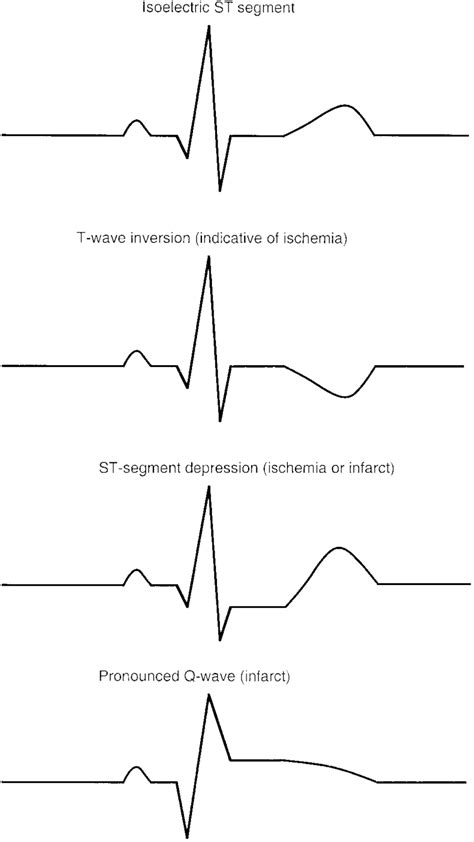 Normal Ecg Reading