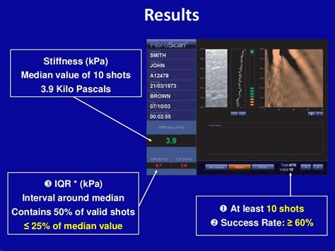 Liver stiffness measurement (fibroscan®)