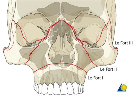 Maxillofacial Trauma: Maxillary Fractures