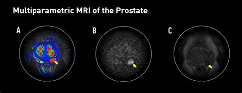 Multiparametric MRI/Ultrasound Fusion Biopsy Improves Prostate Cancer ...