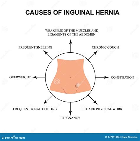 Causes of Inguinal Hernia. Infographics. Vector Illustration on ...