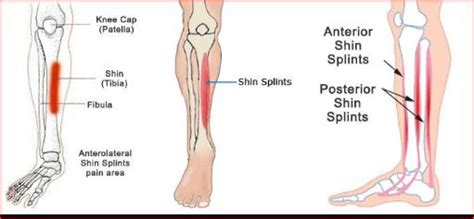 What is Periostitis? Causes and Treatment