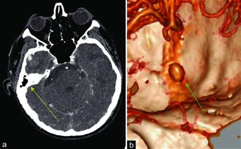 Aneurysm of the right middle meningeal artery in contact with the ...