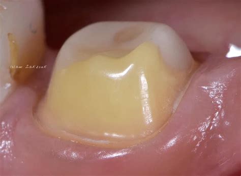 Posterior crown preparation | Dental Esthetics