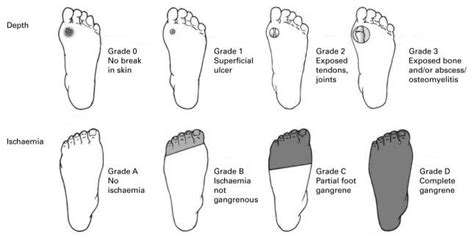 Non Diabetic Ulcers On Feet - DiabetesWalls