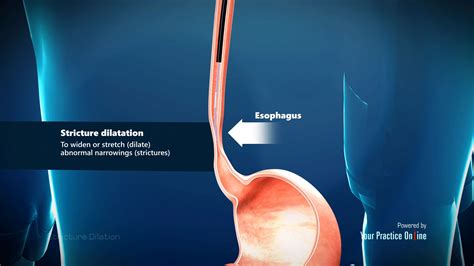 Stricture Dilation Video | Medical Video Library