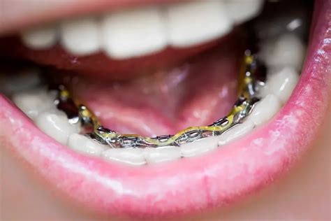 Lingual Braces: Efficacy, Cost & Comparisons | Byte®