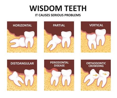 8 Warning Signs for Impacted Wisdom Teeth & 4 Impaction Type