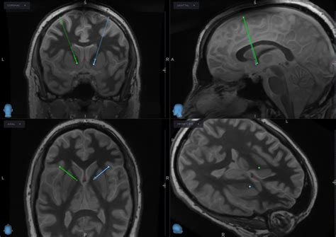 Deep Brain Stimulation (DBS) for Obsessive-Compulsive Disorder (OCD ...