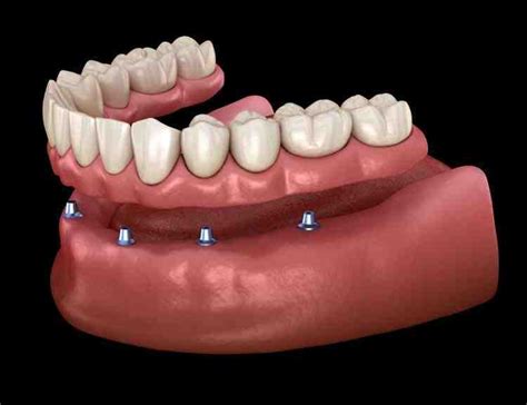 How much are full mouth dental implants - Dental News Network