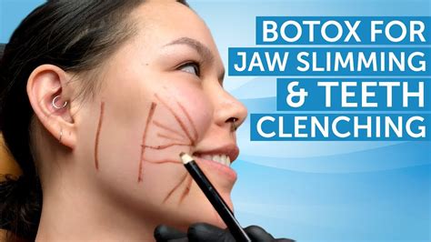 Botox for Jaw Slimming and Teeth Clenching | AAFE - YouTube