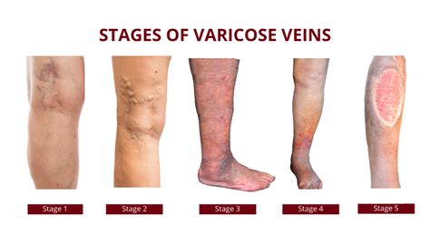 What are Varicose Veins? ,Symptoms, Causes & Treatment, Procedures