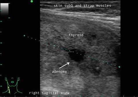 Normal Thyroid Appearance and Anatomic Landmarks in Neck Ultrasound ...